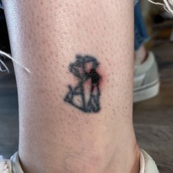 dr LASER - Ruined Tattoo from Laser Hair Removal
