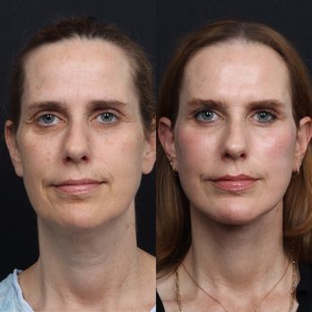 Eos Rejuvenation - Cosmetic Surgeons Near Me - Beverly Hills, California