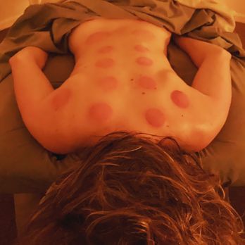 Schofield Massage Therapy - Cupping #releasethetoxins #lymphaticsystem - Massage Therapy Near Me Schofield Massage Therapy - Cupping #releasethetoxins #lymphaticsystem - Massage Therapy Near Me
