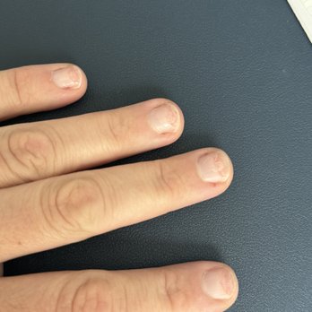 The Nailtural - Ring of fire after nails came off - Nail Salons Near Me - Temecula, California The Nailtural - Ring of fire after nails came off - Nail Salons Near Me - Temecula, California