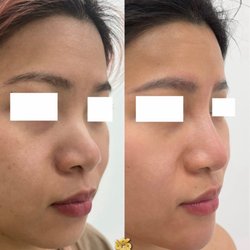 Phi MD Aesthetics - Nose filler