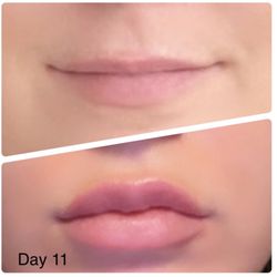 Simply Injectables - Lips before procedure (top photo) and lips on day 11 after 1 syringe of Juvèderm Ultra Plus.