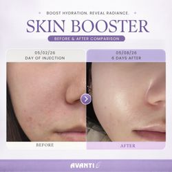 Skin Booster