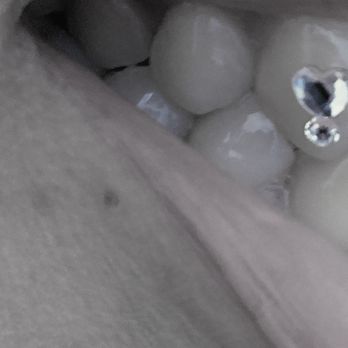 Kinoko Tooth Gems - Heart tooth gem - Teeth Whitening Near Me Kinoko Tooth Gems - Heart tooth gem - Teeth Whitening Near Me
