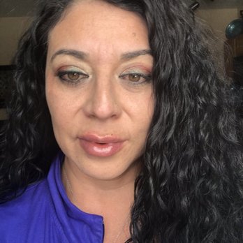 The Skin RN - Later the same day after injections - Medical Spas Near Me - Albuquerque, New Mexico The Skin RN - Later the same day after injections - Medical Spas Near Me - Albuquerque, New Mexico