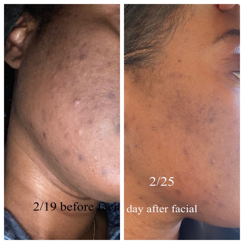 Daniel Behroozan, MD, FAAD, FACMS - This is a before and after. I'll be going back in 2 weeks for any treatment. - Dermatologists Near Me - Beverly Hills, California