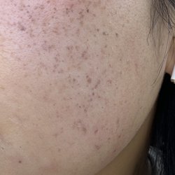 Skin Beauty Laser Center - Before