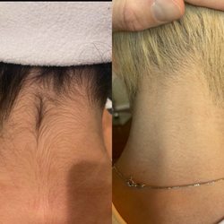 Nkdskin Aesthetics - Laser hair removal results