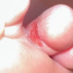 LUX NAIL SPA - Chemical burn from pedicure service