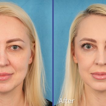 Chicago Oculofacial Plastic Surgery - 42 year old patient came to us looking for a natural solution to upper eyelid heaviness--and after an upper blepharoplasty combined with CO2 - Plastic Surgeons Near Me - Chicago, Illinois