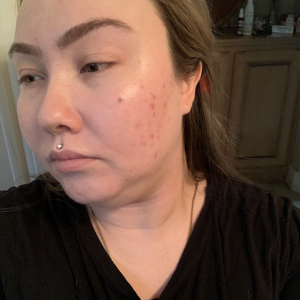 Golden Hour Collective - During!!! So much progress - Skin Care Near Me - Pleasanton, California Golden Hour Collective - During!!! So much progress - Skin Care Near Me - Pleasanton, California