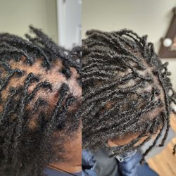 OM SCALP Micropigmentation & Hairline Tattoo Clinic - Womens hair density by Anna