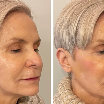 GLOW MediSpa - Filler - Laser Hair Removal Near Me - Chicago, Illinois