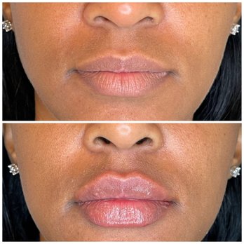 Vitali Medspa - lip filler before and after - Medical Spas Near Me - Pooler, Georgia Vitali Medspa - lip filler before and after - Medical Spas Near Me - Pooler, Georgia