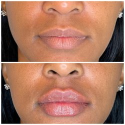 Vitali Medspa - Lip filler before and after