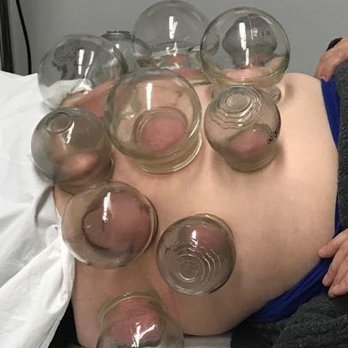 Hope Acupuncture & Herbs Clinic - Cupping treatment - Acupuncture Near Me - Redlands, California
