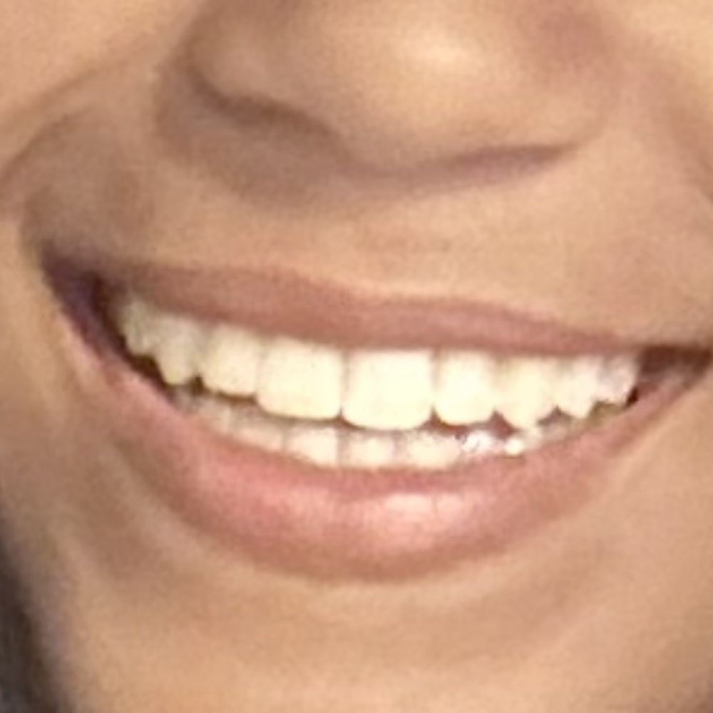 Beautiful smile! Thank you Sunga Ortho!