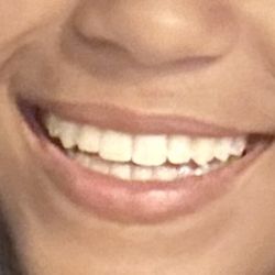 Sunga Orthodontics - Beautiful smile! Thank you Sunga Ortho!