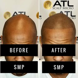 ATL Scalp Micro - Before and After Scalp Micropigmentation Black Men Atlanta at ATL Scalp Micro