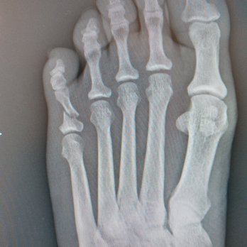 UMC Quick Care - This is my pinky toe which was broken and I had no idea I just thought I had cut it real bad - Urgent Care Near Me - Las Vegas, Nevada UMC Quick Care - This is my pinky toe which was broken and I had no idea I just thought I had cut it real bad - Urgent Care Near Me - Las Vegas, Nevada