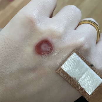 English Dermatology - Desert Ridge - After cleaning with the water and peroxide - Dermatologists Near Me - Phoenix, Arizona