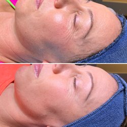 The Body Boutique - Microchanneling treatment before and after just one treatment!