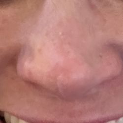 Anthony R Bittar, MD - Nose 14 months after paying for a rhinoplasty and septoplasty.