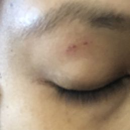 Next day so painful I cannot even wash my face. Next day so painful I cannot even wash my face.