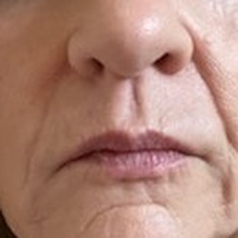 Pasadena Dermatology - Before filler with Dr. Shipman - Dermatologists Near Me - Pasadena, California