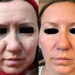 DERMÉ Med Spa - Microneedling with stem cells/exosomes (1 treatment)