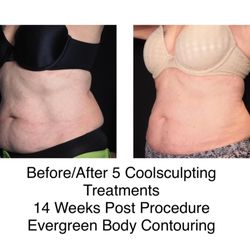 Evergreen Body Contouring