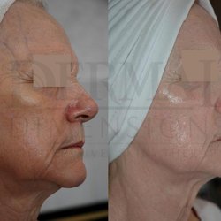 Dermal Dimensions Progressive Skin Therapy - Pigmentation, lines, firmness in a 78 yr. old client.
