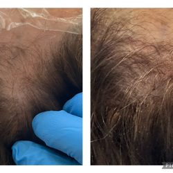 Hoku Beauty - Cold plasma Scalp Therapy