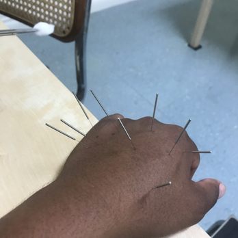 Chuy Acupuncture - First session with Dr. Chuy - Acupuncture Near Me - El Monte, California