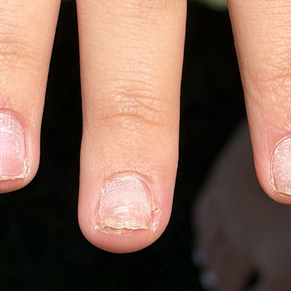 Jet Nails and Spa - Look at my poor girls nails. Now she needs to let them heal before she gets acrylic done again - Nail Salons Near Me - Marina Del Rey, California Jet Nails and Spa - Look at my poor girls nails. Now she needs to let them heal before she gets acrylic done again - Nail Salons Near Me - Marina Del Rey, California