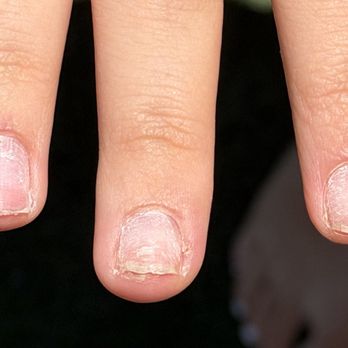Jet Nails and Spa - Look at my poor girls nails. Now she needs to let them heal before she gets acrylic done again - Nail Salons Near Me - Marina Del Rey, California Jet Nails and Spa - Look at my poor girls nails. Now she needs to let them heal before she gets acrylic done again - Nail Salons Near Me - Marina Del Rey, California