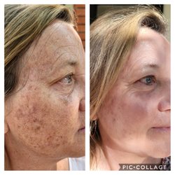 Urban Laser - Urban laser, helping another person get ready to take their facial mask off and show their beautiful skin!