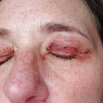 Texas Eye and Aesthetic Center - Two weeks later -- August 2021 - Ophthalmologists Near Me - Plano, Texas
