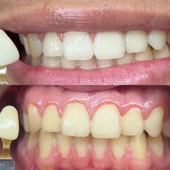 The Coco Blanc Teeth Whitening - Amazing Results ! - Teeth Whitening Near Me - Whittier, California The Coco Blanc Teeth Whitening - Amazing Results ! - Teeth Whitening Near Me - Whittier, California
