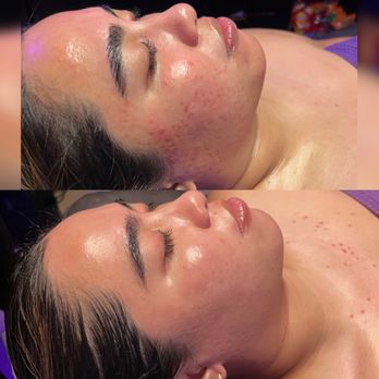 Patricia Esthetics - Series of 4 bioRepeels - Skin Care Near Me - Salida, California