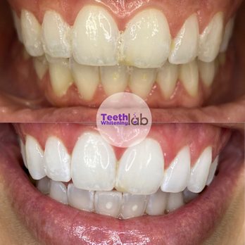 Teeth Whitening Lab - Teeth Whitening Near Me - Long Beach, California Teeth Whitening Lab - Teeth Whitening Near Me - Long Beach, California
