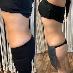 Hummingbird Body Sculpting - Working with wood therapy on her abdomen and side's