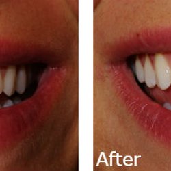 Harbor East Dental - Before and After