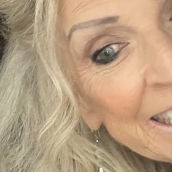 Hodari MD Dermatology & Rejuvené - After! Wow!! Dr. Hodari did a fabulous job getting all the squamous cell cancer out, stitched me up! No bad scar Wow!