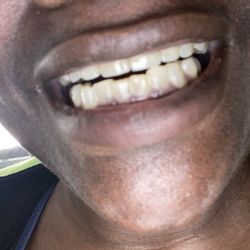 Murphree Dental - J. Murphree corrected my smile and I'm loving it!!