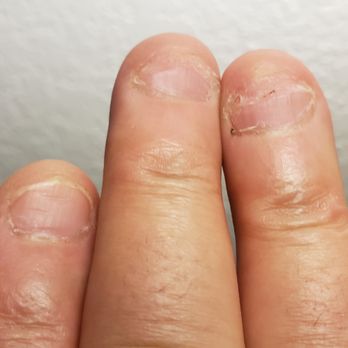 Roy Abadi Hypnotherapy - Fingers before - Hypnosis/Hypnotherapy Near Me - Long Beach, California