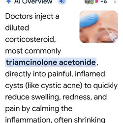 Associates In Dermatology - How to remove a simple cyst.
