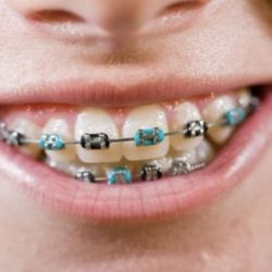 The Lakewood Dentist - Get That Straight Smile You Deserve!