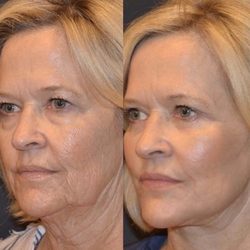 femme lash and brow - Plasma Skin Tightening Combined with BB Glow Facials bring the Skin Back in Time.(before&after)