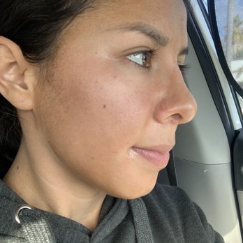 Gold Coast Aesthetics - On the day the chemical peel solution was applied my face looked like I had gotten a tan. No burning or irritation. - Medical Spas Near Me - Costa Mesa, California Gold Coast Aesthetics - On the day the chemical peel solution was applied my face looked like I had gotten a tan. No burning or irritation. - Medical Spas Near Me - Costa Mesa, California